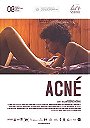 Acné                                  (2008)