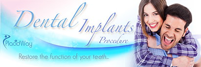 Best Dental Implants in Mexico
