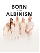 Born with Albinism