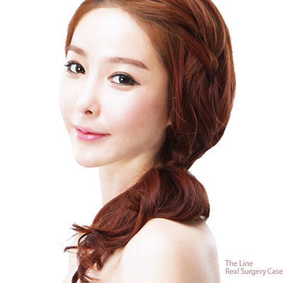 Facial Contouring in Korea within affordable cost