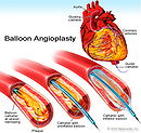 Angioplasty