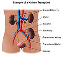 Kidney Treatment at Mirage Healthcare