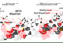 Thalassemia