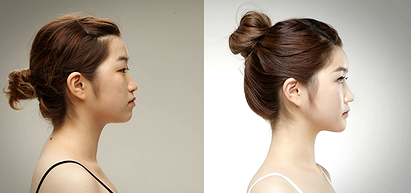 V-Line Surgery [The Line Plastic Surgery Clinic]